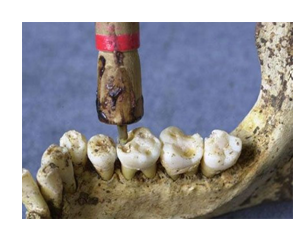 «Следует терпеть и молиться». Как лечили зубную боль в древности? | Аргументы и Факты