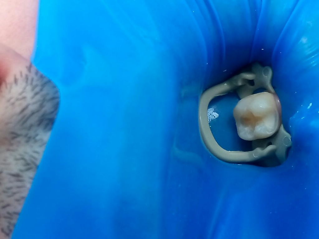 Поэтапное восстановление жевательной поверхности зуба с помощью силиконового ключа