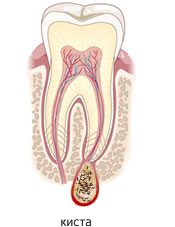 Что такое киста в зубе, как ее диагностируют и лечат