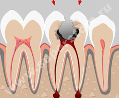 Что такое киста в зубе, как ее диагностируют и лечат