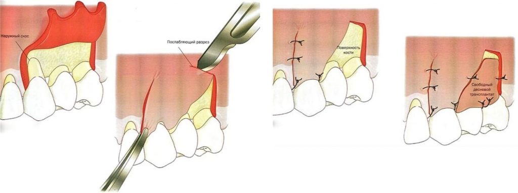 Лоскутная операция в стоматологии
