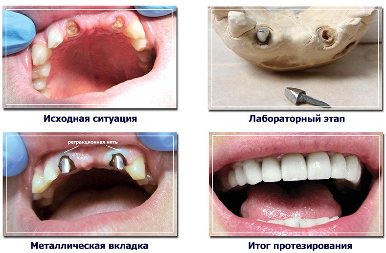 Культевые вкладки на зубы