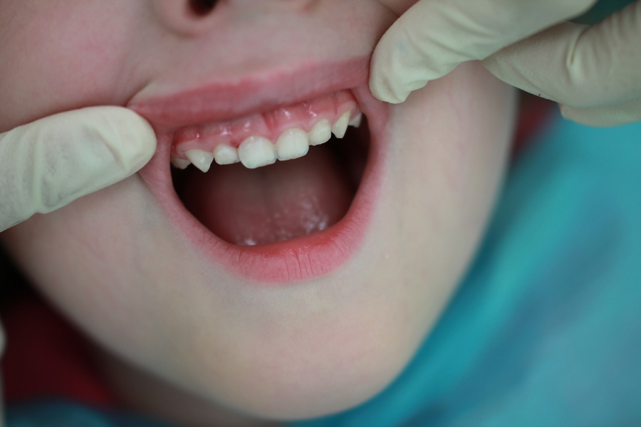 Лечение кариеса молочного зуба