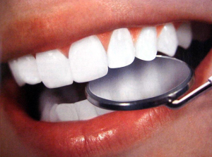 Внутрикоронковое отбеливание зубов