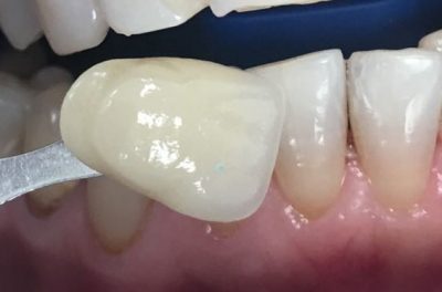 Отбеливание Zomm-4