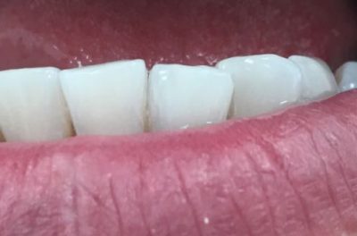 Отбеливание Zomm-4