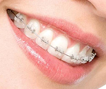 Скобы для зубов - сколько стоят и для чего нужны?