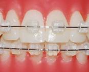 Скобы для зубов - сколько стоят и для чего нужны?