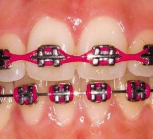 Металлические брекеты