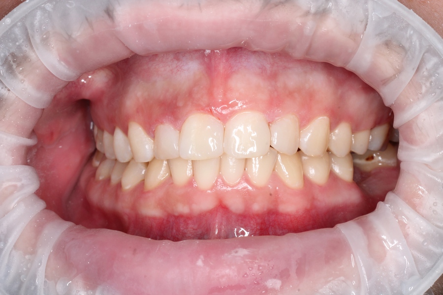 Реставрация фронтальных зубов (фото после лечения).