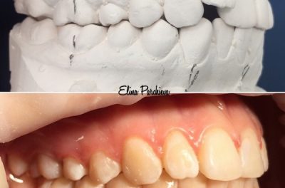 Ортодонтическое лечение верхней челюсти керамическими брекетами, нижней челюсти металлическими брекетами. Срок лечения 16 месяцев.