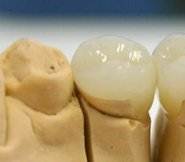 Протезирование без обточки зубов