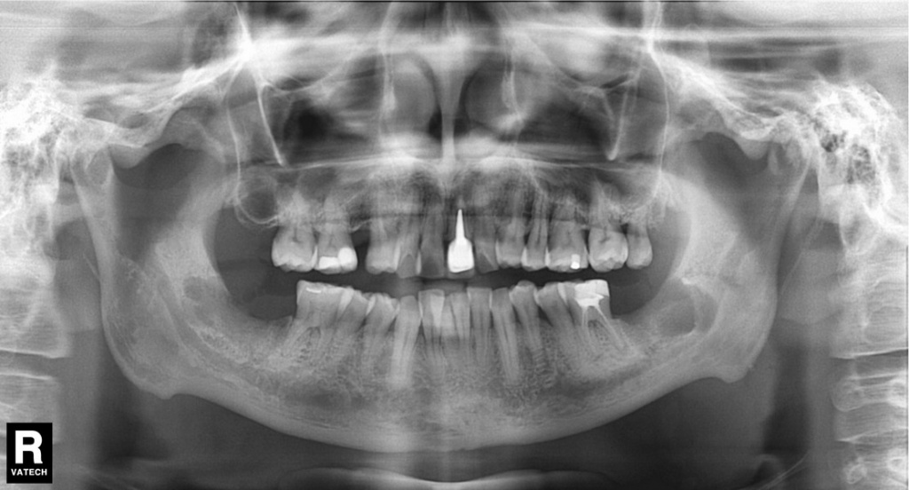 Удаление дистопированных зубов