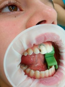 Детская стоматология - примеры работ