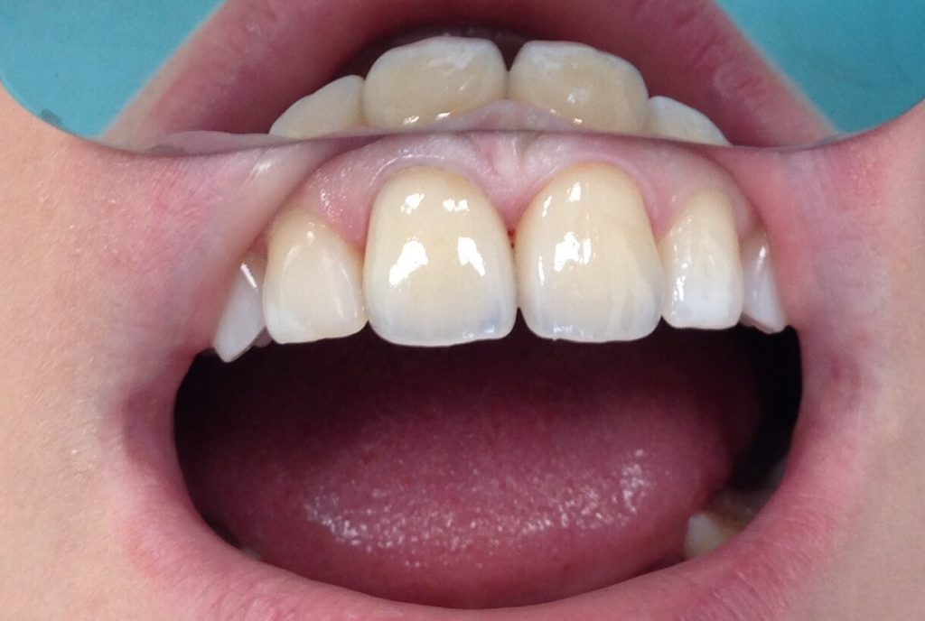 Причины болей зуба под коронкой