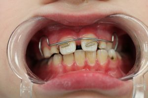 Лазерная стоматология - примеры работ