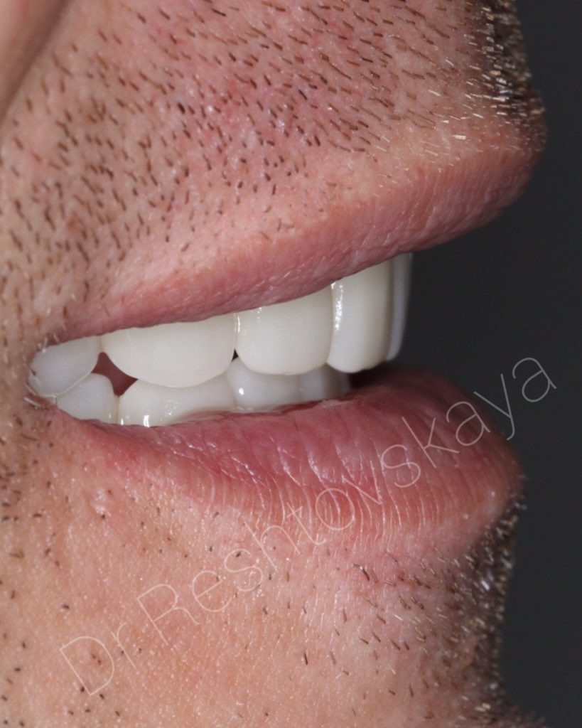 Условно-съёмный протез на верхней, нижней челюсти на четырёх импланататах