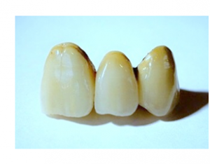Потеря одного зуба – какой вид протезирования выбрать?