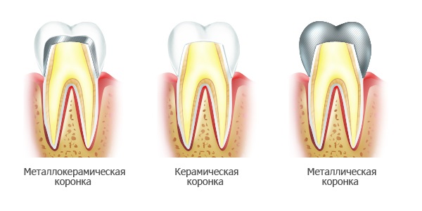 Вставить зубы: способы несъемного протезирования и виды коронок