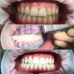 Лазерная стоматология - примеры работ