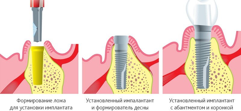 Как выполняется и сколько стоит имплантация зуба