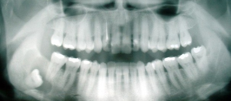 Киста зуба – как возникает, как лечить?