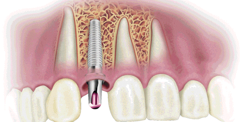 Методы имплантации зубов в современной стоматологии. Интервью с доктором Путь В.А.