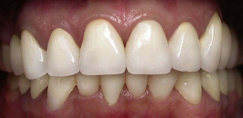 От чего зависит естественный цвет зубов