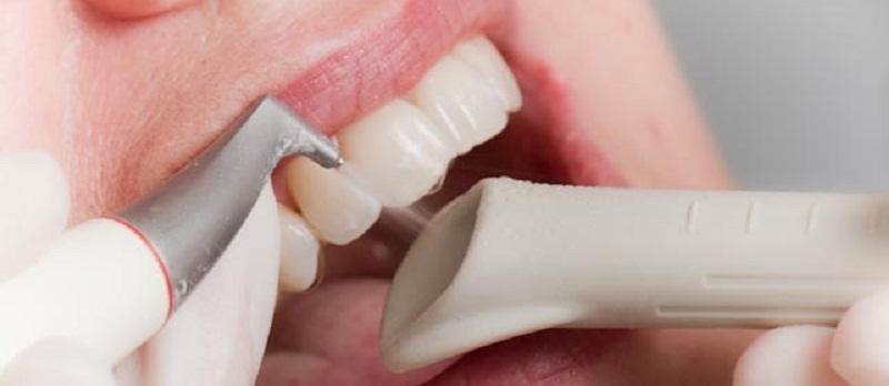 Шлифовка и полировка зубов — стоматология Василенко