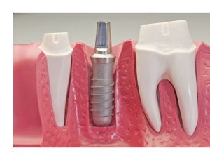 Потеря одного зуба – какой вид протезирования выбрать?