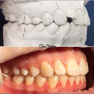Ортодонтия - примеры работ