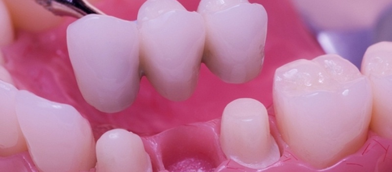 Технологии протезирования зубов. Что предпочесть?