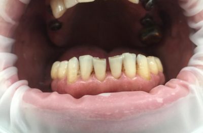 имплантация зубов и протезирование