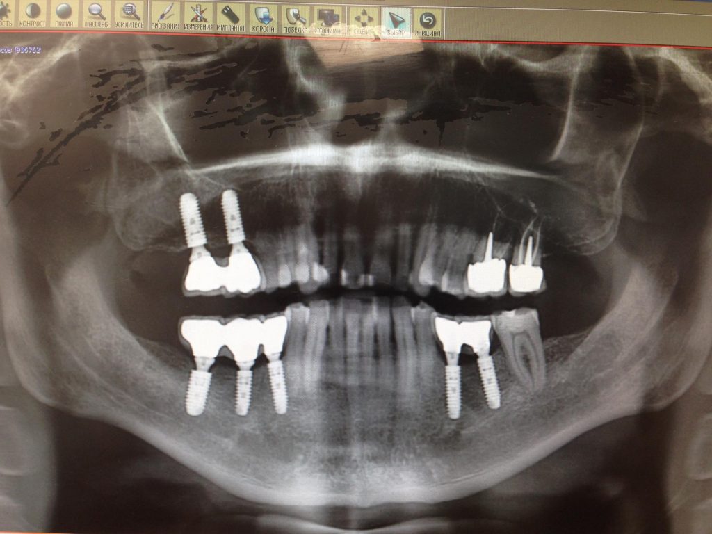 Имплантация жевательных зубов, верхняя и нижняя челюсть ( Денисов И.А. ) 07.05.2016