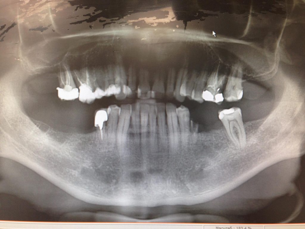 Имплантация жевательных зубов, верхняя и нижняя челюсть