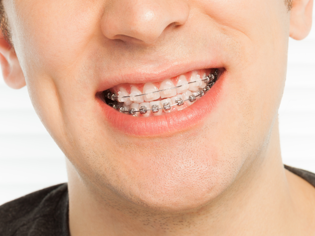 Можно ли ставить брекеты, если отсутствуют по 2 крайних зуба на верхней челюсти?