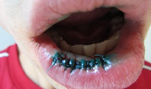 Лечение слизистой оболочки рта