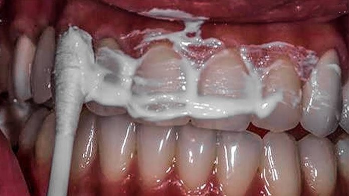 Как удаляют зубной камень в стоматологии: все современные способы