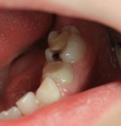 Лечение кариеса молочных зубов