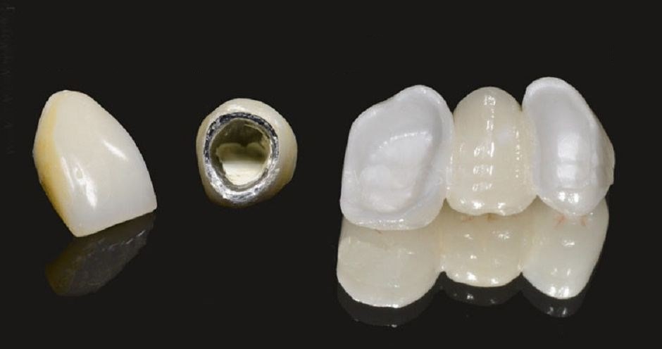 Металлокерамические конструкции зубов