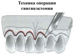 Гингивэктомия что это такое. Смотреть фото Гингивэктомия что это такое. Смотреть картинку Гингивэктомия что это такое. Картинка про Гингивэктомия что это такое. Фото Гингивэктомия что это такое