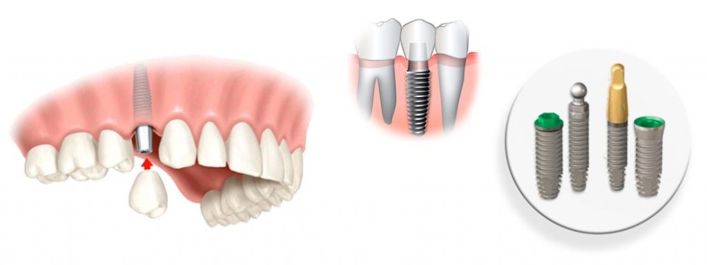 имплантация зубов под ключ
