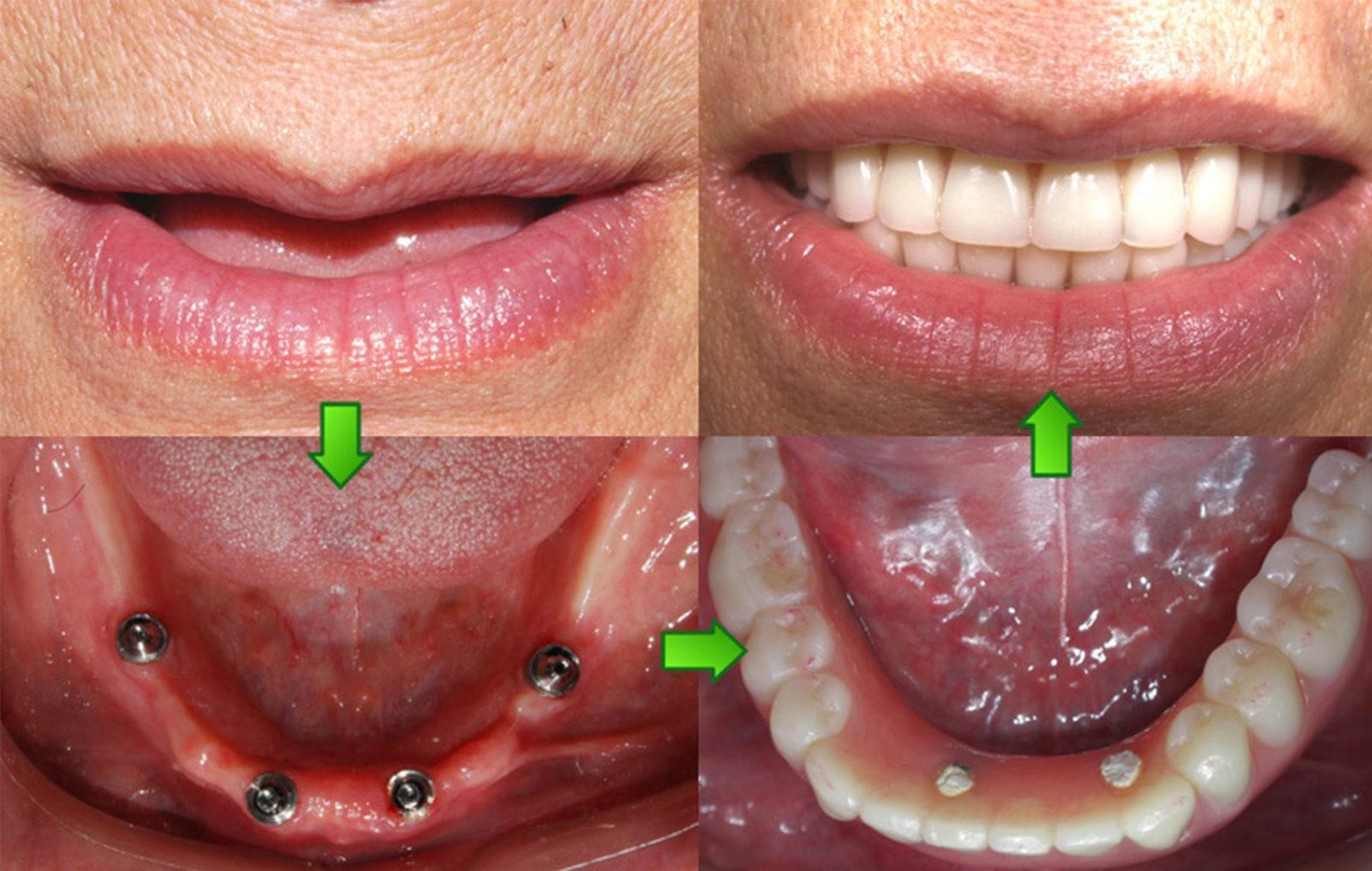 Можно ли восстановить два отсутствующих зуба одним имплантом