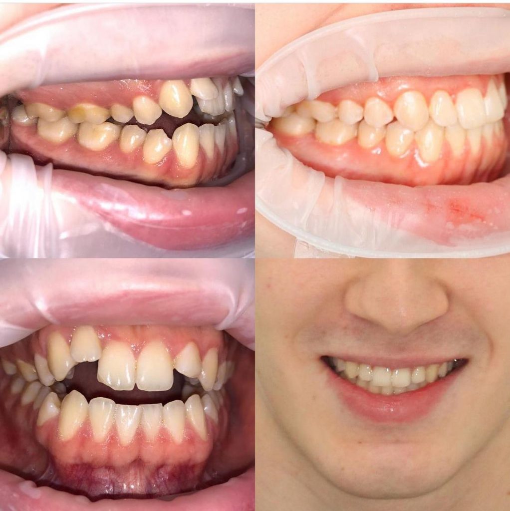 неровный зубной ряд