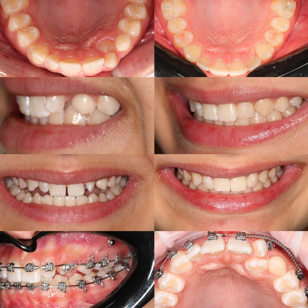 промежутки между зубами