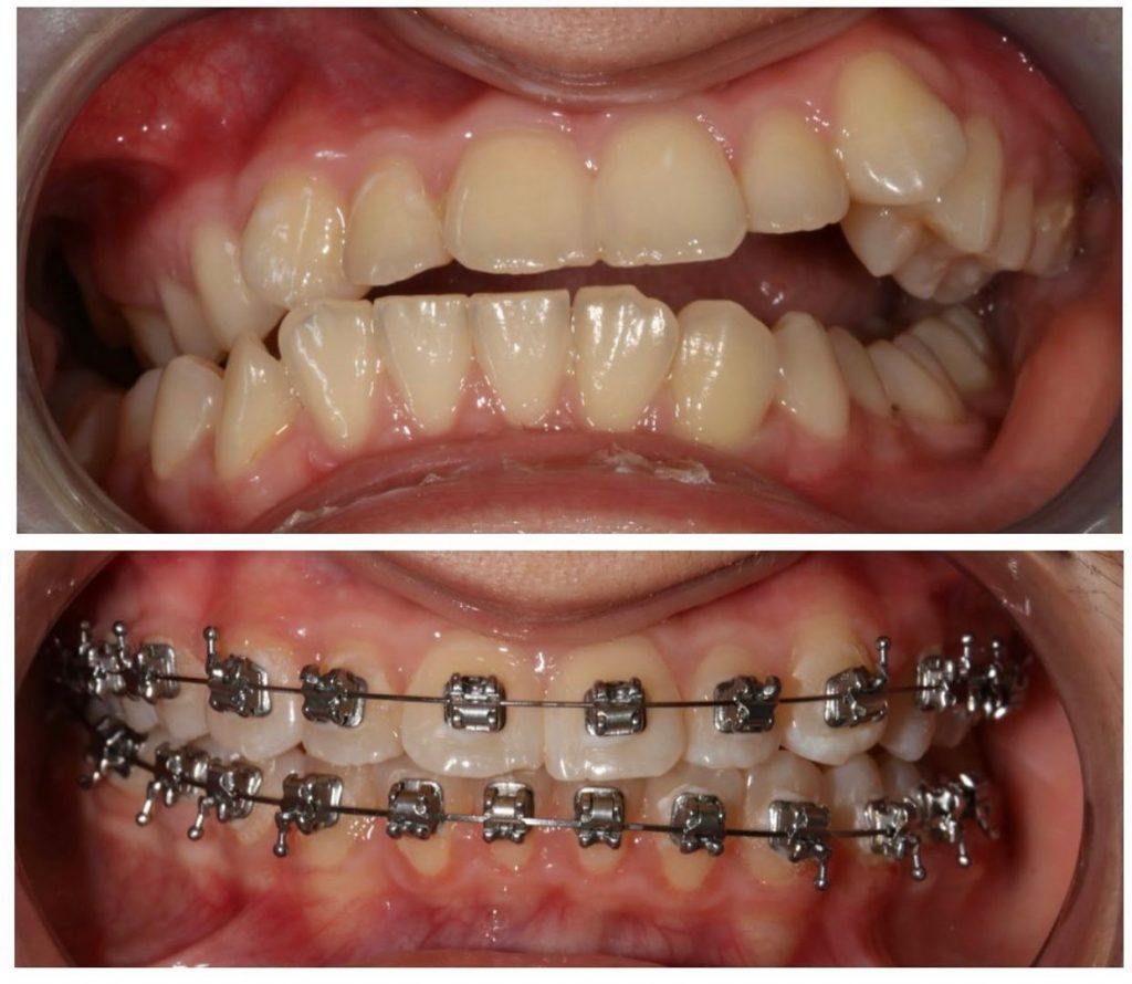 ортодонтическое лечение на брекетах Инновация