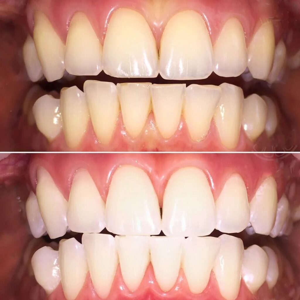 Плюсы и минусы отбеливания зубов