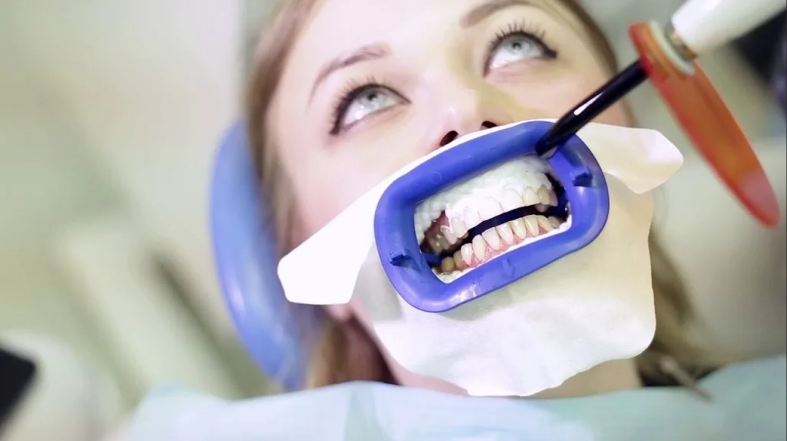 Отбеливание у стоматолога