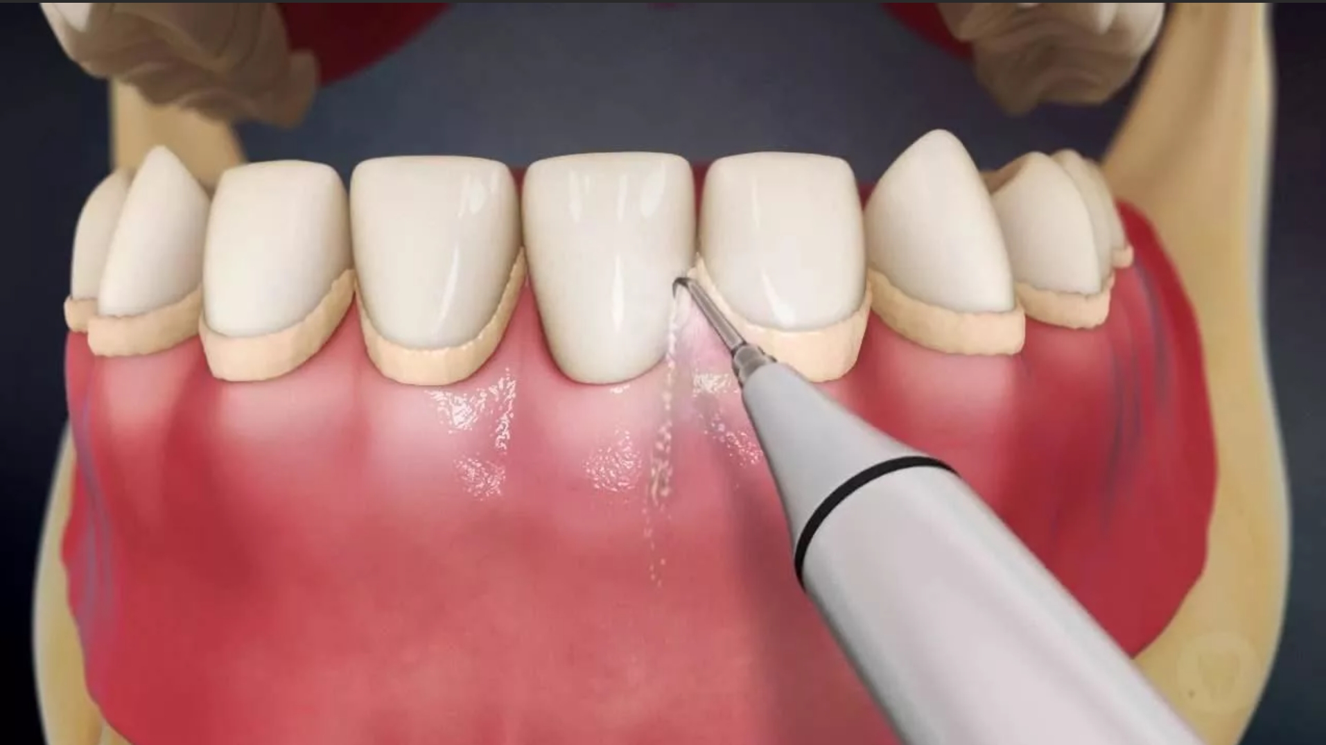 Чистка зубов после лечения. Профгигиена (ультразвук + Air-Flow). Скейлинг пародонтальных карманов. Поддесневой зубной камень.