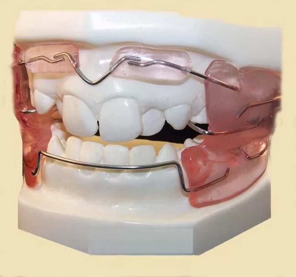 аппарат френкеля ортодонтия